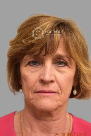 Natural Eyelid Surgery Before and After | Northside Plastic Surgery