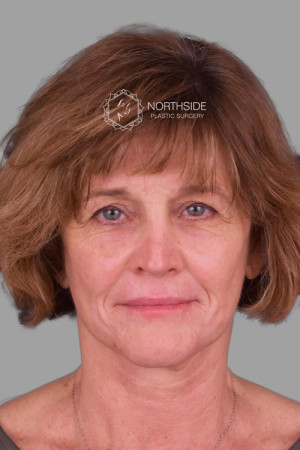 Natural Eyelid Surgery Before and After | Northside Plastic Surgery