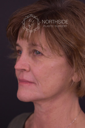 Natural Eyelid Surgery Before and After | Northside Plastic Surgery