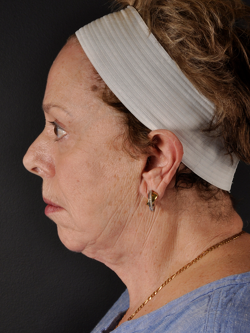 Natural Facelift Before and After | Northside Plastic Surgery