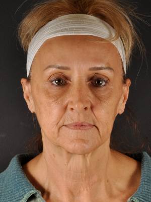 Natural Facelift Before and After | Northside Plastic Surgery