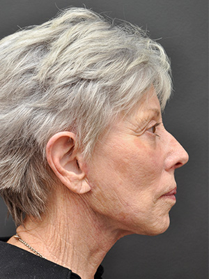 Natural Facelift Before and After | Northside Plastic Surgery