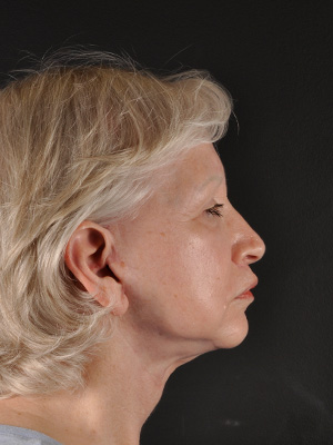 Natural Facelift Before and After | Northside Plastic Surgery