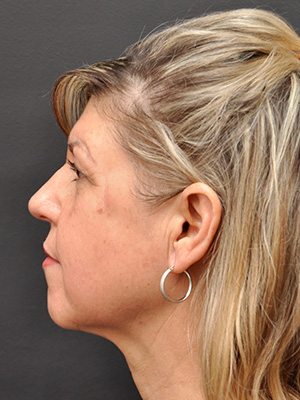 Natural Facelift Before and After | Northside Plastic Surgery