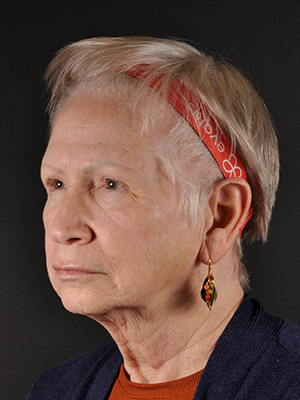 Natural Facelift Before and After | Northside Plastic Surgery