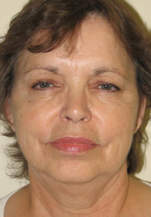 Natural Facelift Before and After | Northside Plastic Surgery