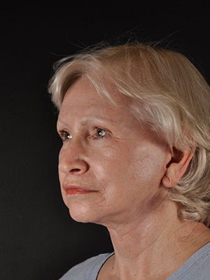 Natural Facelift Before and After | Northside Plastic Surgery