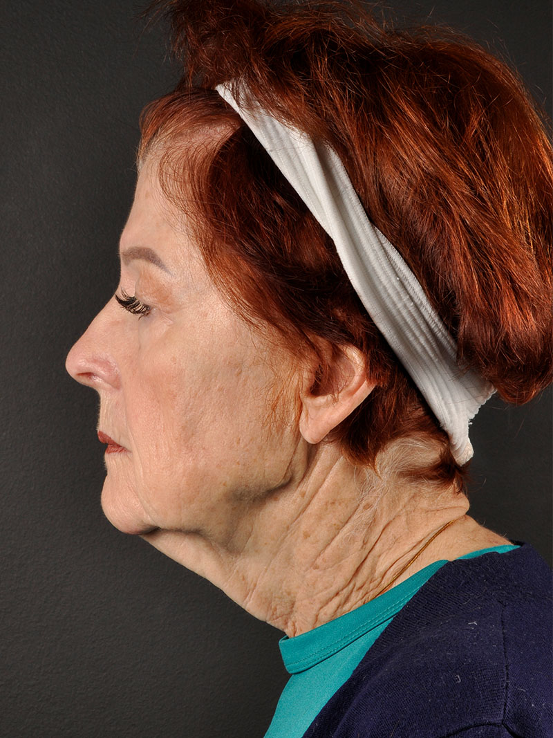 Natural Facelift Before and After | Northside Plastic Surgery