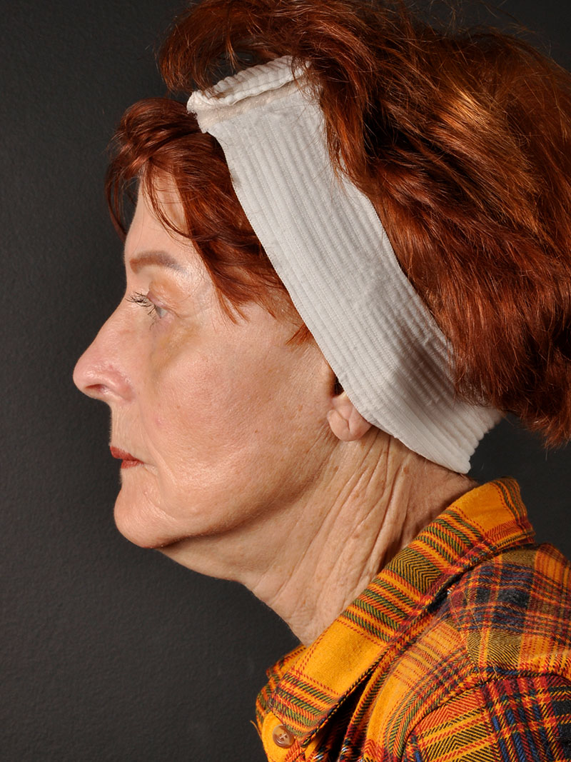 Natural Facelift Before and After | Northside Plastic Surgery
