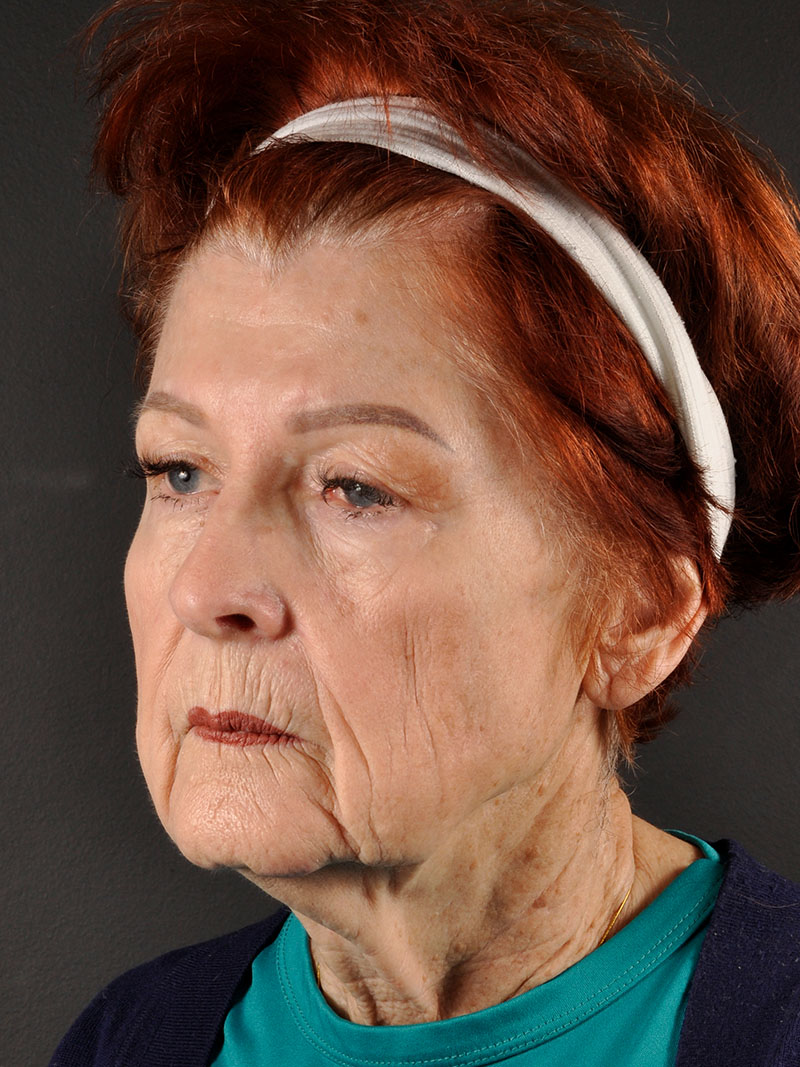 Natural Facelift Before and After | Northside Plastic Surgery