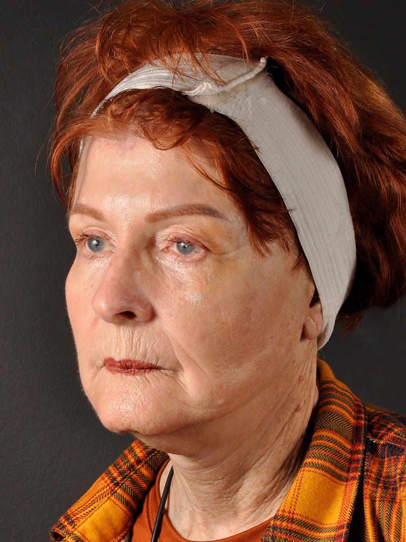 Natural Facelift Before and After | Northside Plastic Surgery