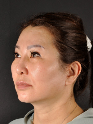Natural Facelift Before and After | Northside Plastic Surgery