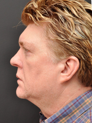 Natural Facelift Before and After | Northside Plastic Surgery