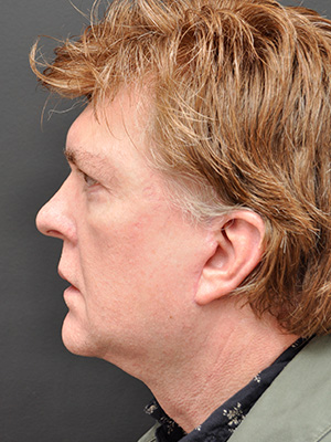 Natural Facelift Before and After | Northside Plastic Surgery