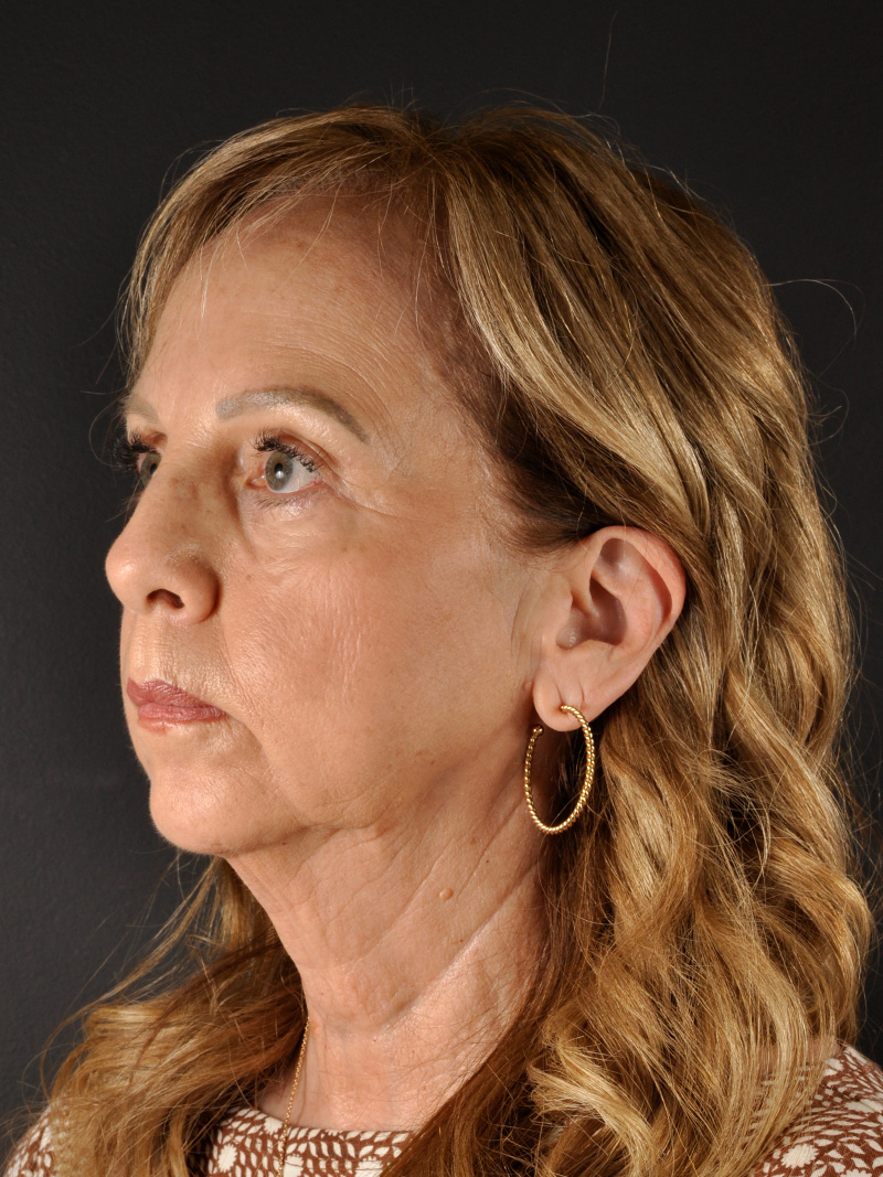 Natural Facelift Before and After | Northside Plastic Surgery