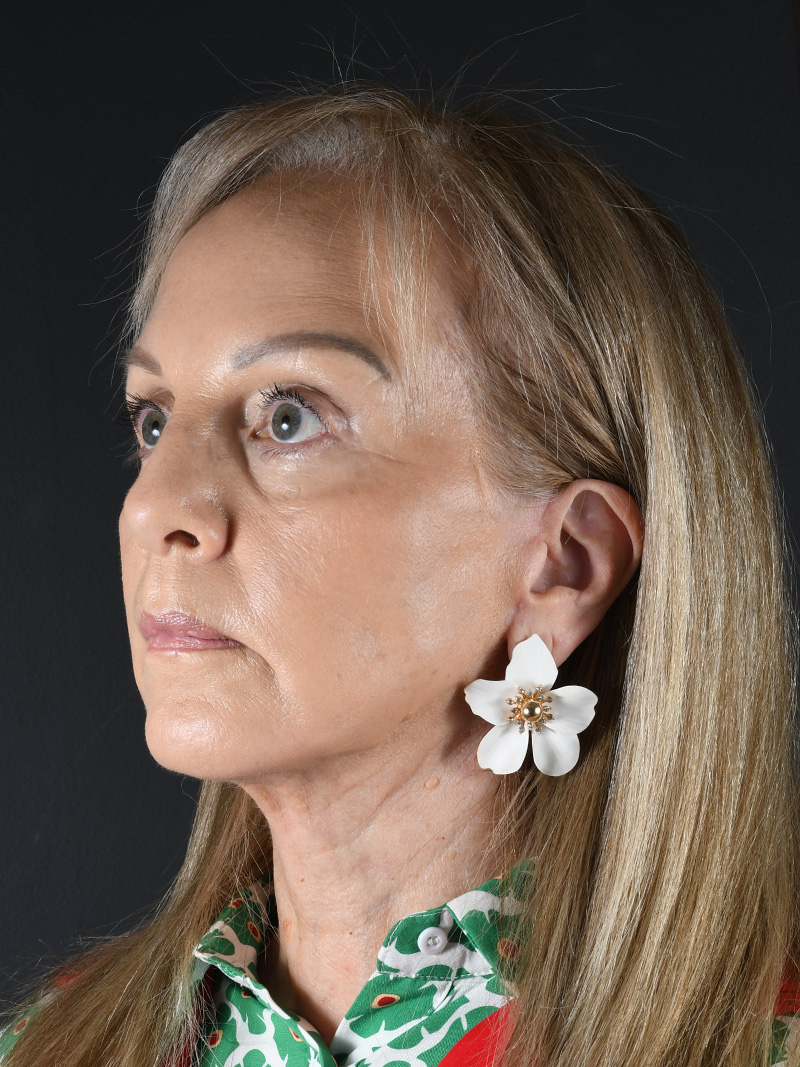 Natural Facelift Before and After | Northside Plastic Surgery