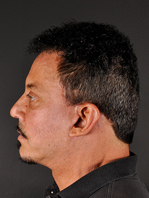 Natural Facelift Before and After | Northside Plastic Surgery