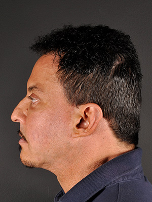Natural Facelift Before and After | Northside Plastic Surgery
