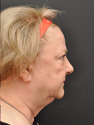 Natural Facelift Before and After | Northside Plastic Surgery