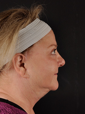 Natural Facelift Before and After | Northside Plastic Surgery