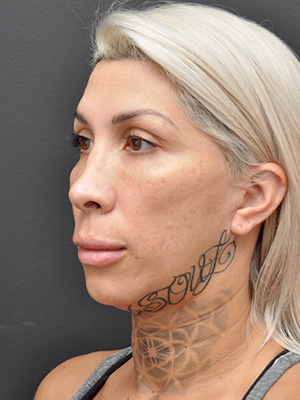 Natural Facelift Before and After | Northside Plastic Surgery