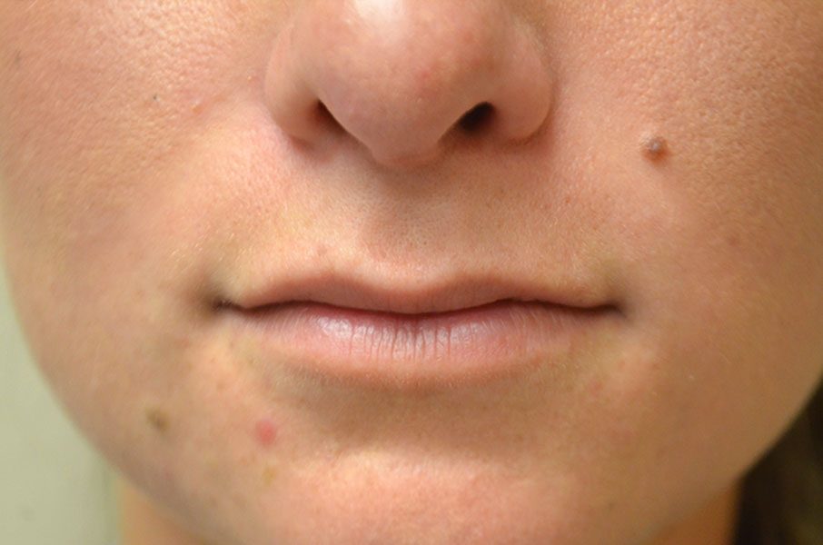 Non-Surgical Lip Augmentation