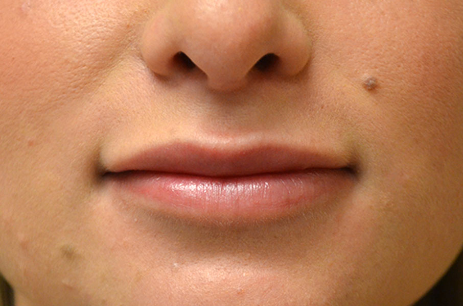 Natural Lip Augmentation Before and After | Northside Plastic Surgery