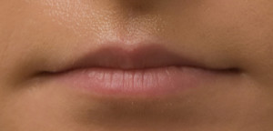 Non-Surgical Lip Augmentation