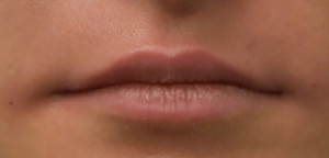 Non-Surgical Lip Augmentation