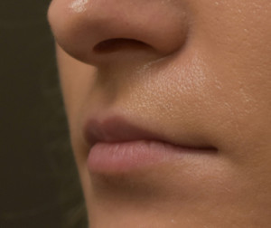 Natural Lip Augmentation Before and After | Northside Plastic Surgery