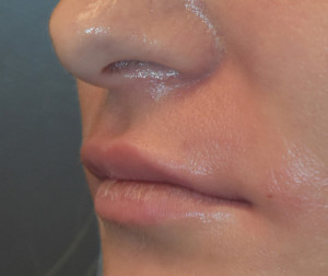 Natural Lip Augmentation Before and After | Northside Plastic Surgery