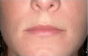 Natural Lip Augmentation Before and After | Northside Plastic Surgery