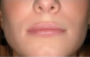 Natural Lip Augmentation Before and After | Northside Plastic Surgery