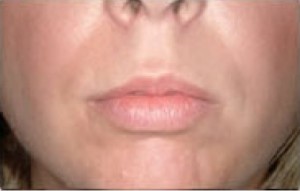 Natural Lip Augmentation Before and After | Northside Plastic Surgery