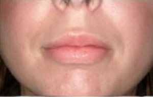 Natural Lip Augmentation Before and After | Northside Plastic Surgery