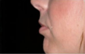 Natural Lip Augmentation Before and After | Northside Plastic Surgery