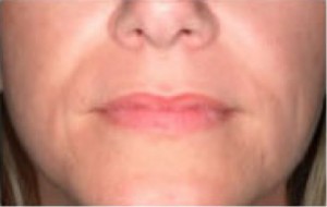 Natural Lip Augmentation Before and After | Northside Plastic Surgery