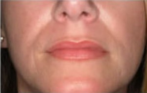 Natural Lip Augmentation Before and After | Northside Plastic Surgery