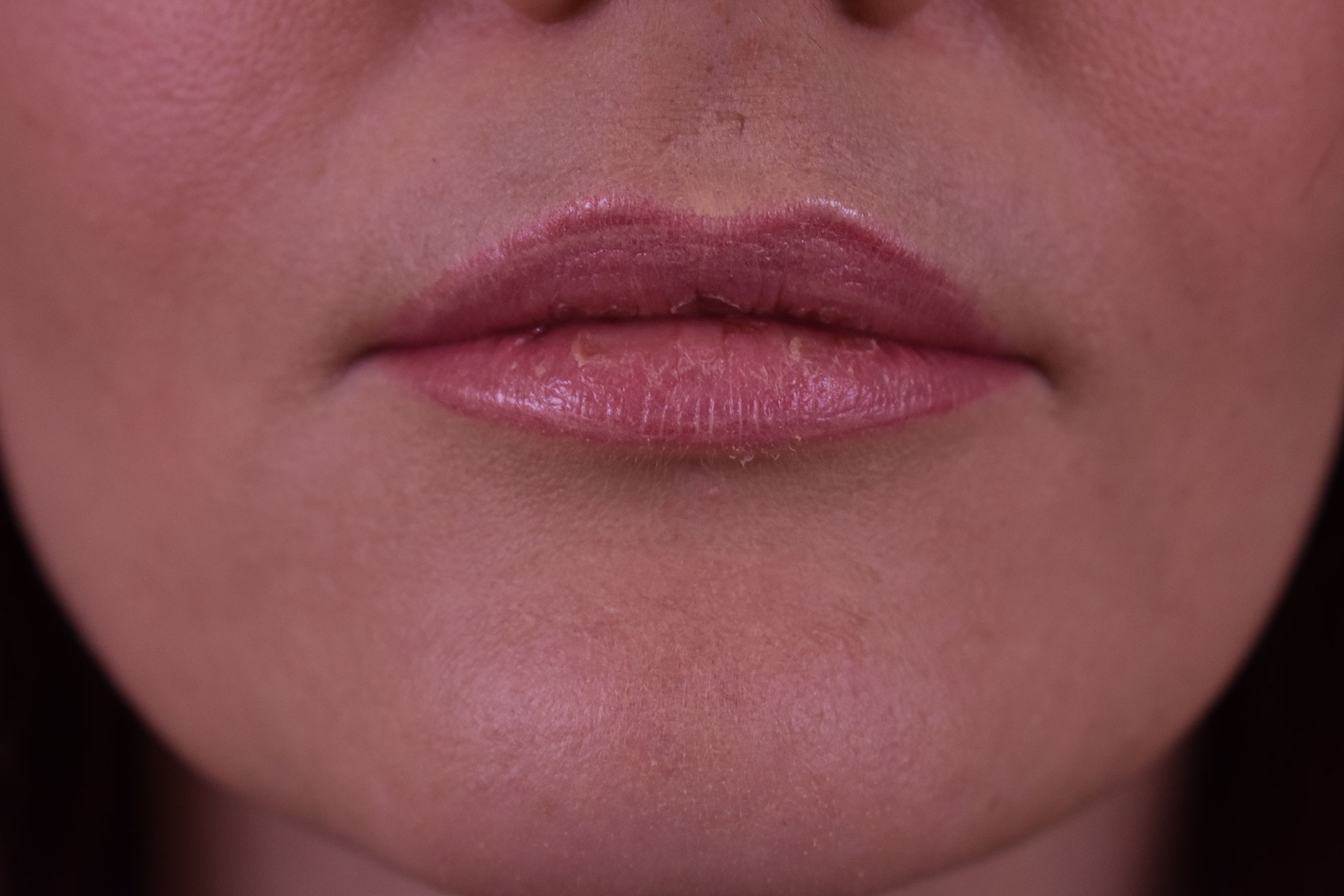 Natural Lip Augmentation Before and After | Northside Plastic Surgery