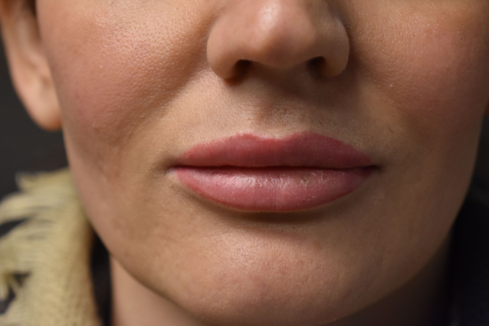 Natural Lip Augmentation Before and After | Northside Plastic Surgery