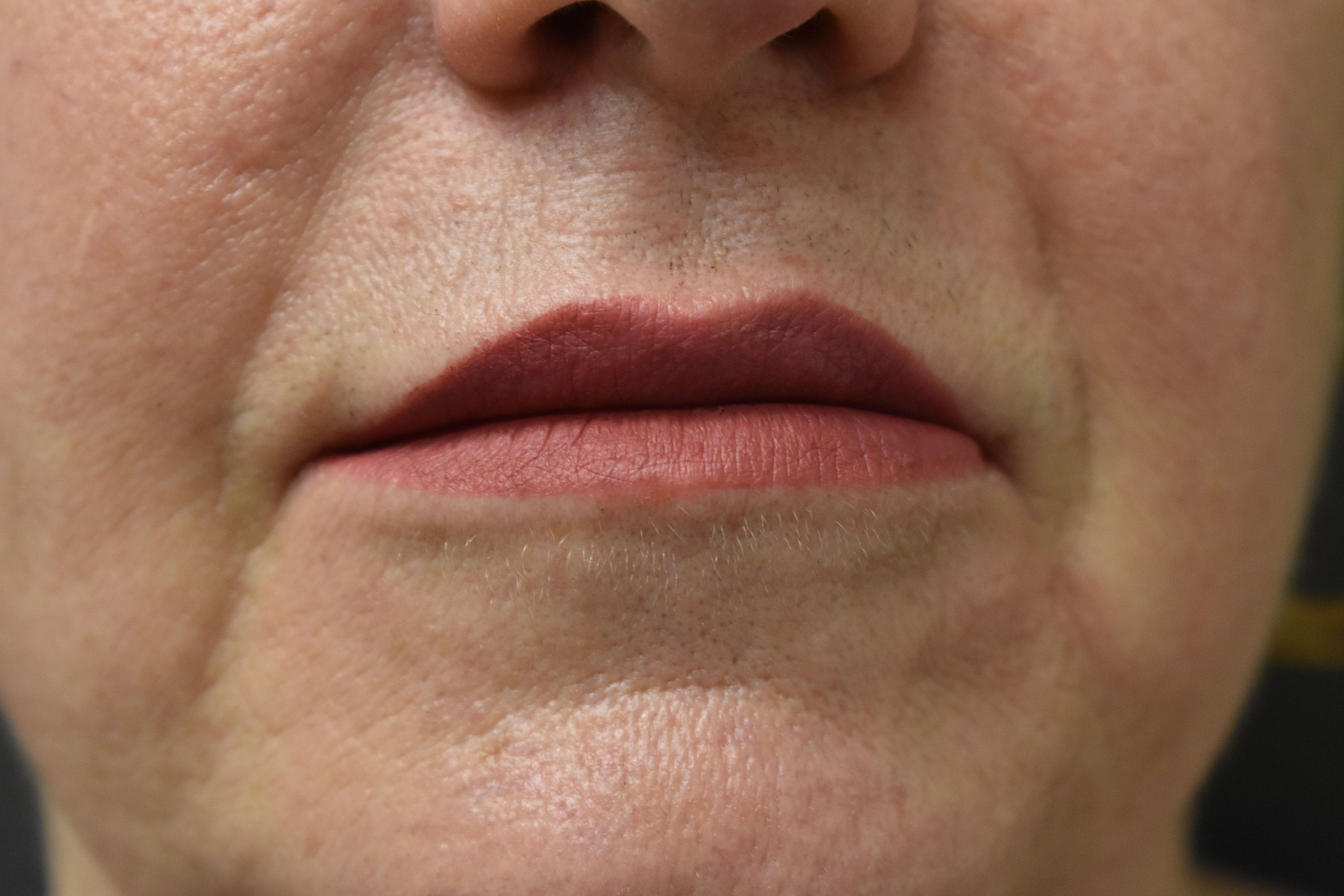 Natural Lip Augmentation Before and After | Northside Plastic Surgery