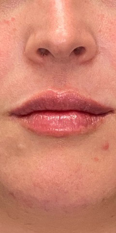 Natural Lip Augmentation Before and After | Northside Plastic Surgery