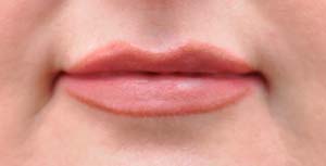 Natural Lip Augmentation Before and After | Northside Plastic Surgery