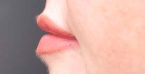 Natural Lip Augmentation Before and After | Northside Plastic Surgery