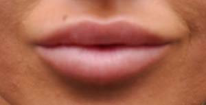 Natural Lip Augmentation Before and After | Northside Plastic Surgery