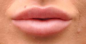 Natural Lip Augmentation Before and After | Northside Plastic Surgery