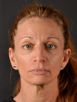 Mini Facelift Atlanta Minimally Invasive Facelift Buckhead