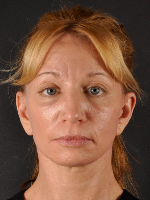 Mini Facelift Atlanta Minimally Invasive Facelift Buckhead