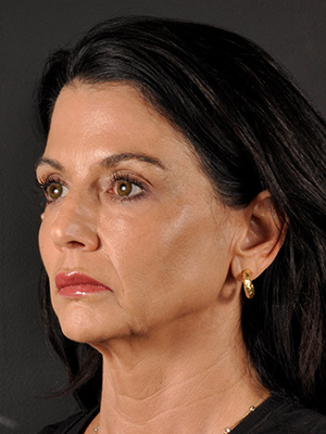 Natural Mini Facelift Before and After | Northside Plastic Surgery