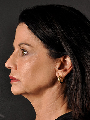 Natural Mini Facelift Before and After | Northside Plastic Surgery